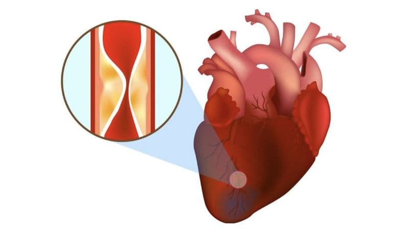 Đặc điểm bệnh nhồi máu cơ tim