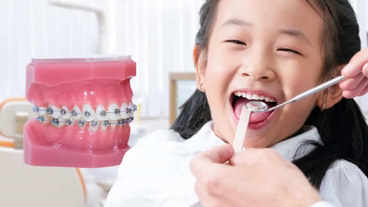 Niềng răng cho trẻ – Những vấn đề cần lưu ý