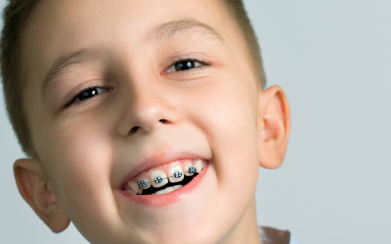 Cách Niềng răng cho trẻ