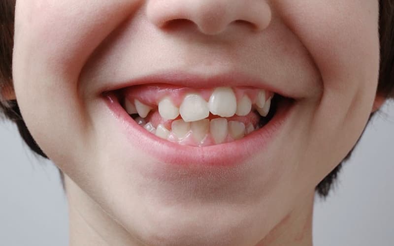 Niềng răng cho trẻ như thế nào