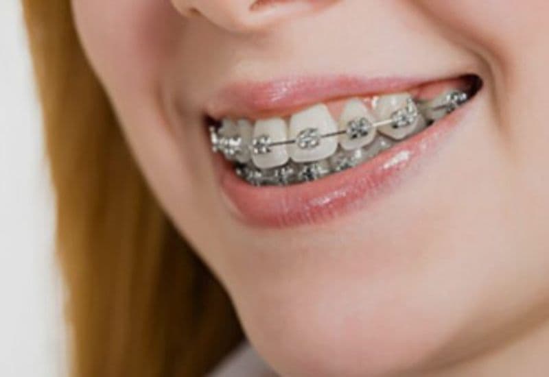 Niềng răng hô hiện đang là một trong những phương pháp thẩm mỹ được yêu thích và lựa chọn rộng rãi.