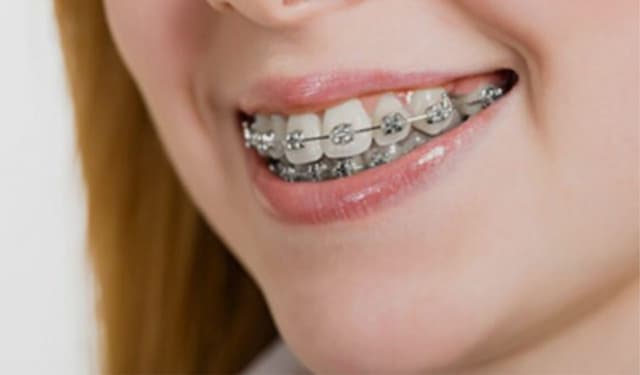 Niềng răng hô là gì? Quy trình, chi phí và những lưu ý quan trọng