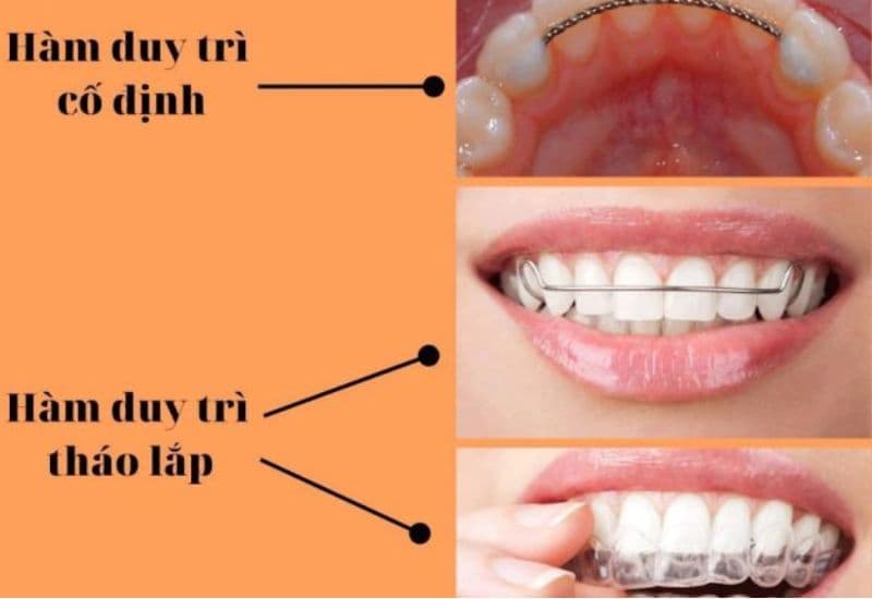 Sau khi niềng răng sứ, đeo hàm duy trì giúp giữ kết quả lâu dài và ngăn ngừa răng quay lại vị trí cũ.