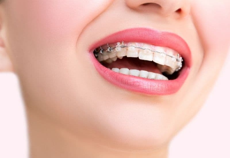 Niềng răng vẩu là phương pháp thẩm mỹ phổ biến, giúp cải thiện nụ cười và tăng sự tự tin trong cuộc sống.