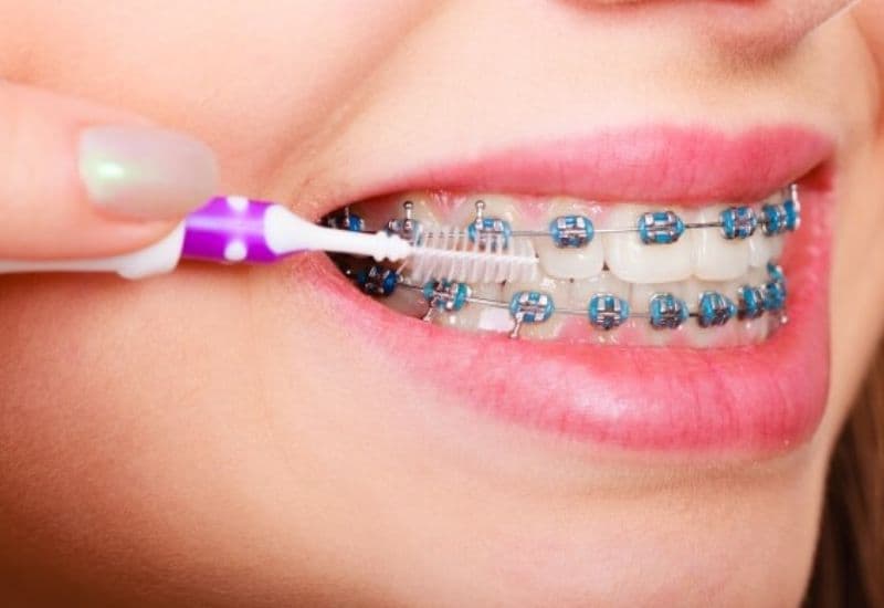 Sau khi niềng răng vẩu, việc vệ sinh răng miệng đúng cách là vô cùng quan trọng.