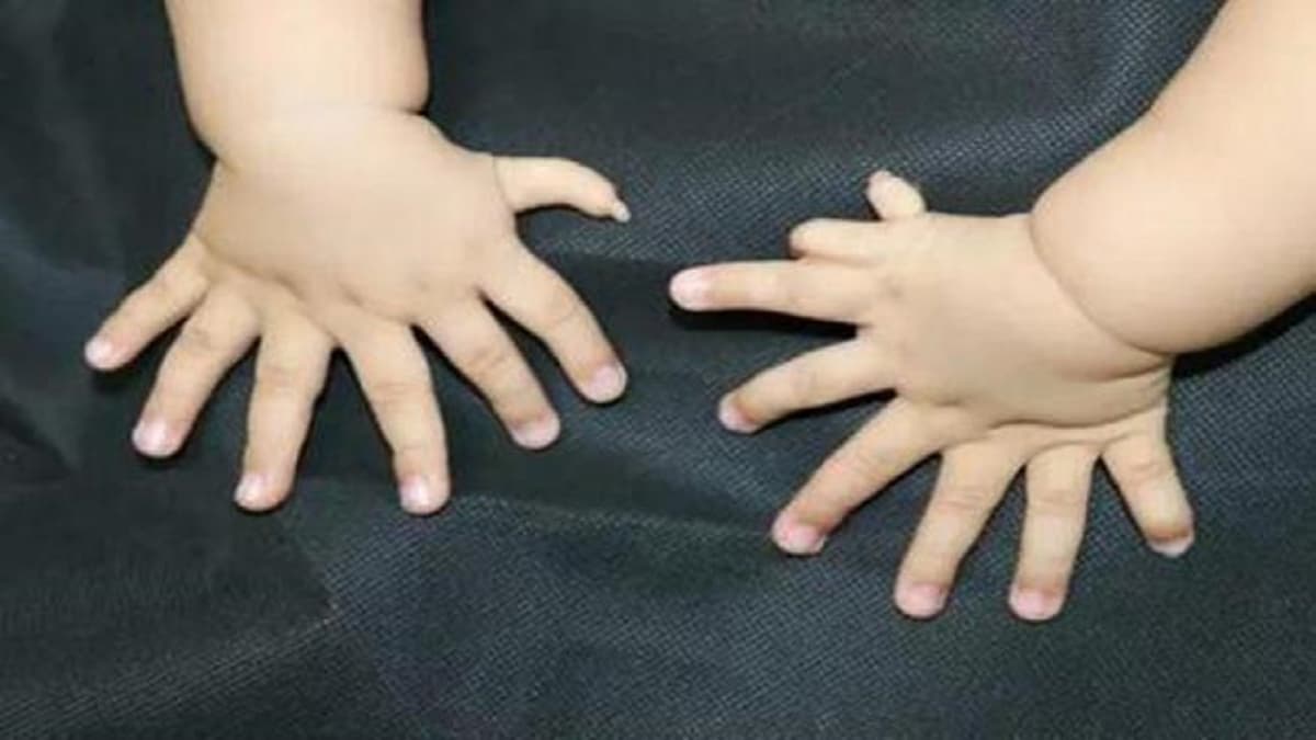 Phẫu thuật thừa ngón tay cái và những điều cần biết
