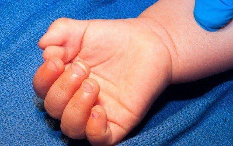 các bác sĩ thường khuyến cáo phẫu thuật nên được thực hiện trước thời điểm bàn tay hoàn chỉnh