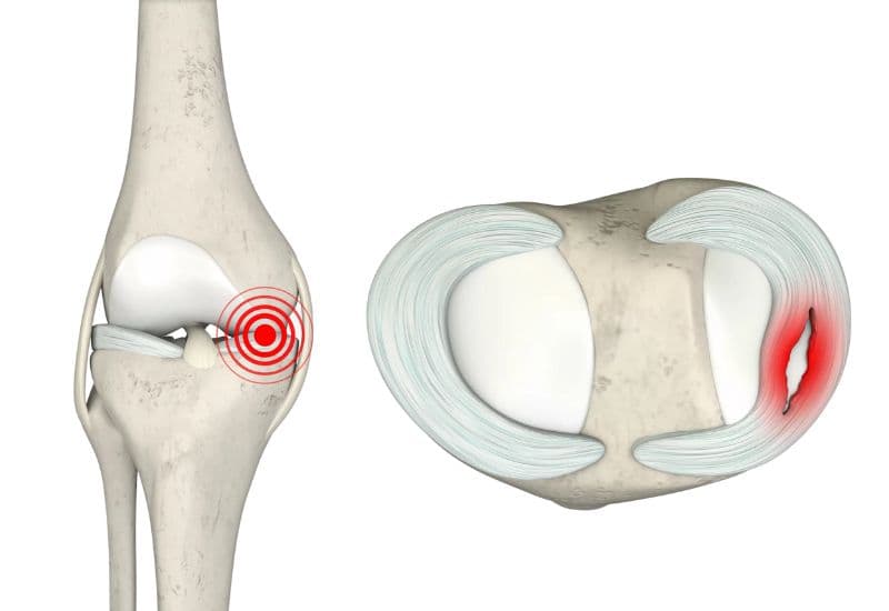 Các cấp độ rách sụn chêm khớp gối