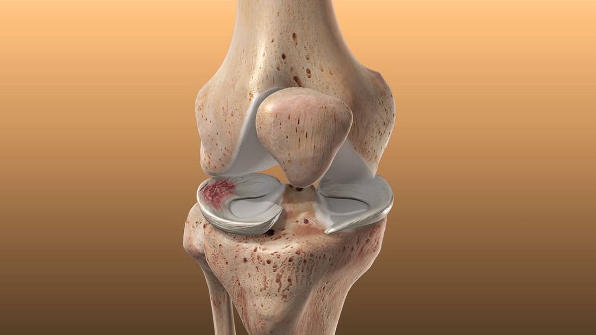 Các cấp độ rách sụn chêm khớp gối và phương pháp điều trị