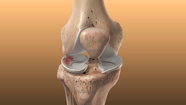 Các cấp độ rách sụn chêm khớp gối và phương pháp điều trị