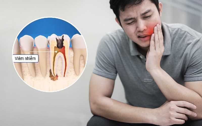 Sâu răng gây nhức đầu vì sao