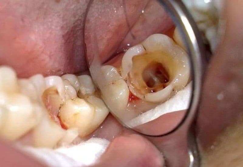 Sâu răng tủy là giai đoạn nặng nhất của bệnh sâu răng, gây tác động nghiêm trọng đến sinh hoạt hàng ngày.