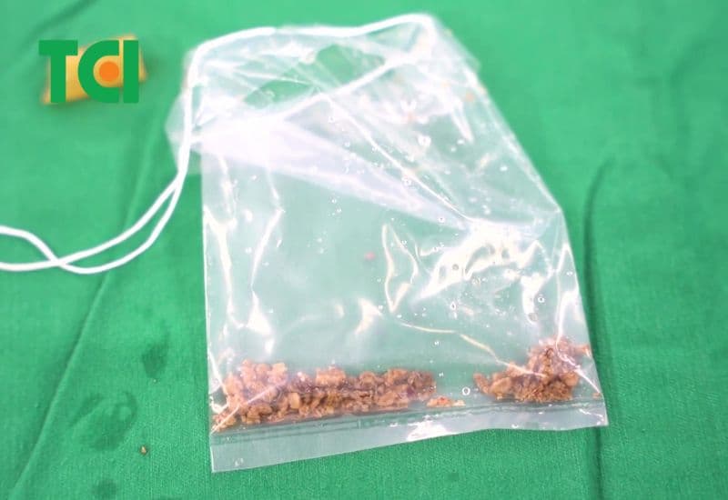 Vì sao cần lựa chọn nơi điều trị sỏi tiết niệu uy tín?