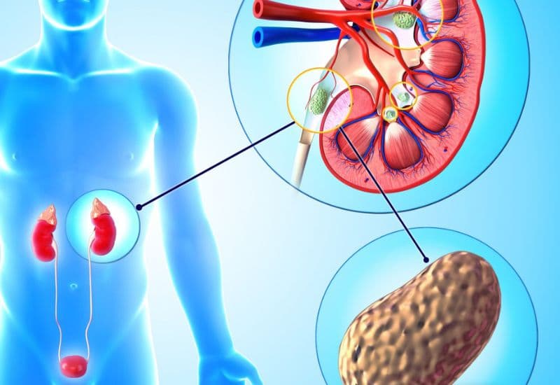 Cơ chế hình thành đài bể thận giãn độ 3