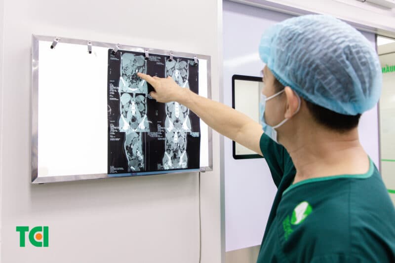 Sỏi gây tình trạng thận ứ nước độ 2