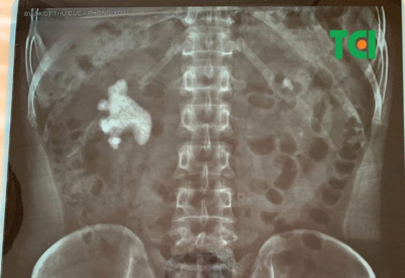 Sỏi san hô là gì và vì sao khó điều trị?