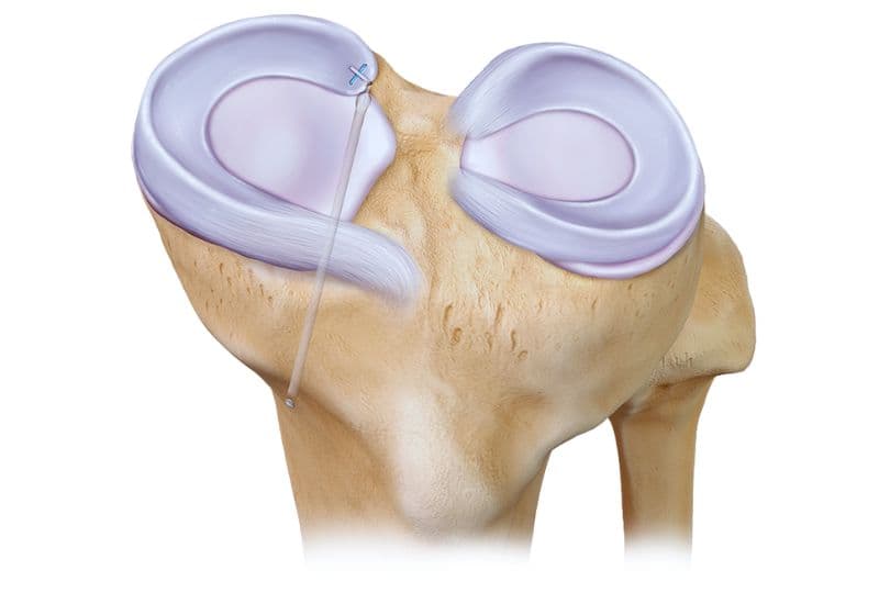 Sụn chêm là gì và vai trò quan trọng trong khớp gối