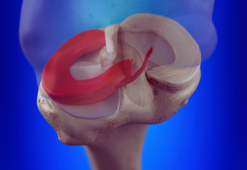 Hiểu đúng về sụn chêm và vai trò của nó trong khớp gối