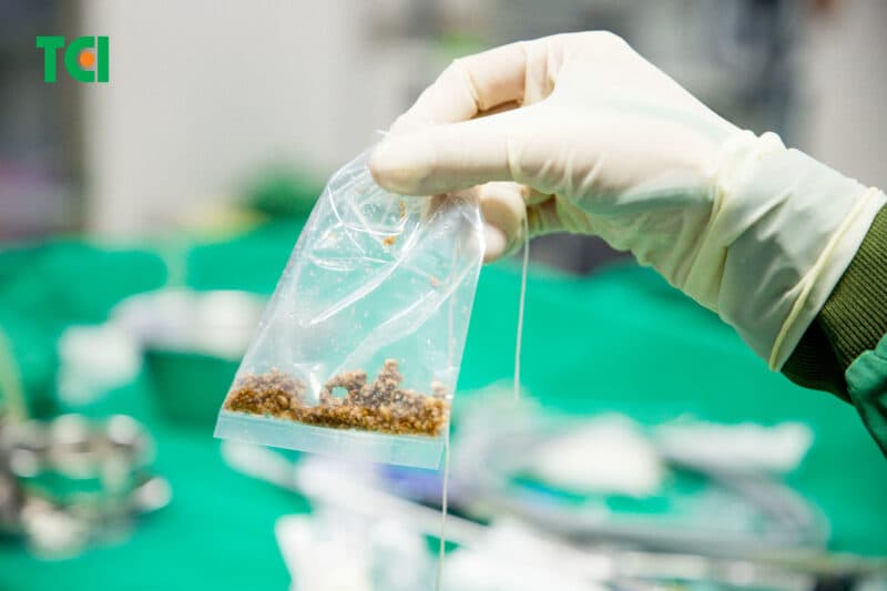 Cách điều trị thận ứ nước cấp độ nặng (độ 3 - 4)