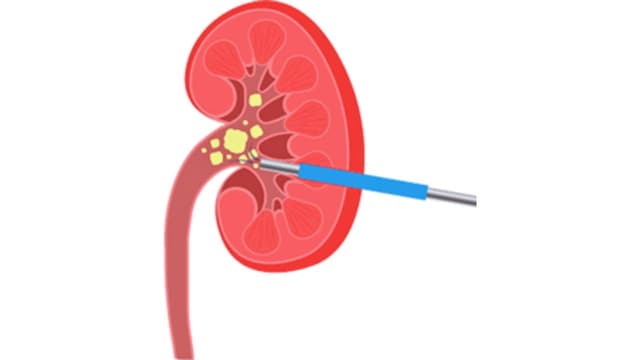 Tán sỏi nội soi qua da ở đâu tốt? Tiêu chí chọn cơ sở uy tín
