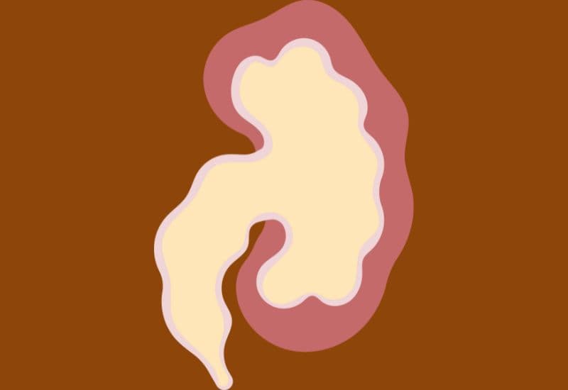 Hiểu đúng về thận ứ nước do hẹp niệu quản