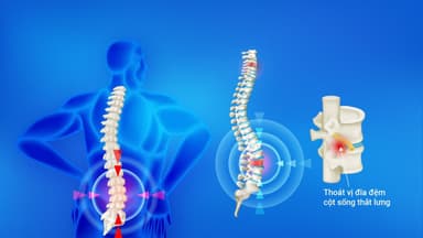 Thoát vị đĩa đệm cột sống thắt lưng: Những sai lầm trong điều trị