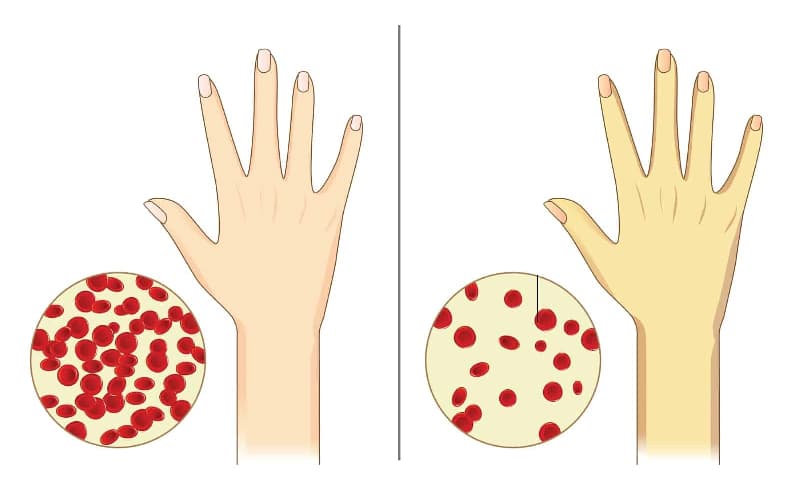 Xem thực đơn cho trẻ thiếu máu thiếu sắt