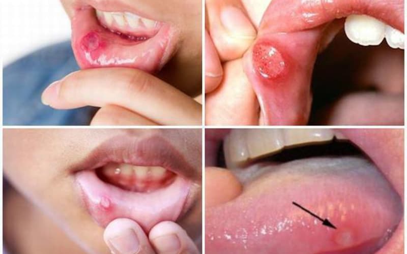 Thuốc chữa nhiệt miệng có loại nào