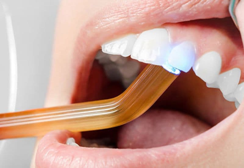 Với tình trạng răng mẻ do sâu, trám răng sứt là giải pháp an toàn và hiệu quả lâu dài. 