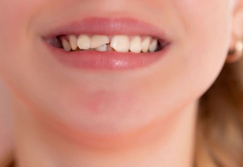 Nhiều người lựa chọn trám răng sứt để khôi phục thẩm mỹ và chức năng răng một cách nhanh chóng.