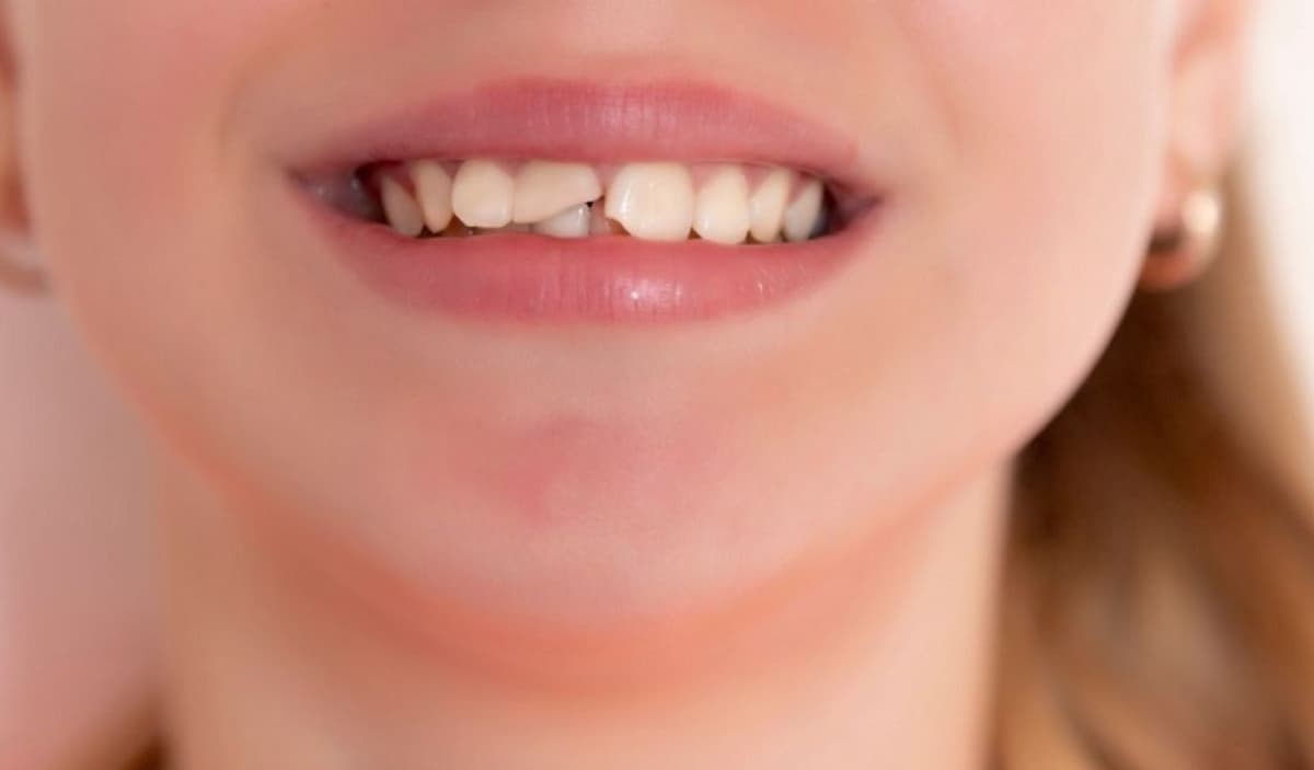 Những điều cần biết trước khi trám răng sứt để đạt hiệu quả lâu dài