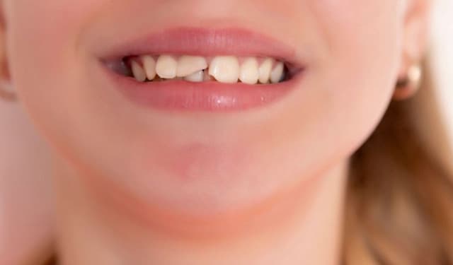 Những điều cần biết trước khi trám răng sứt để đạt hiệu quả lâu dài