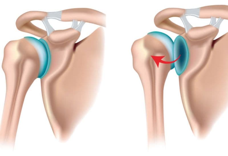 Bị trật khớp vai phải làm sao?