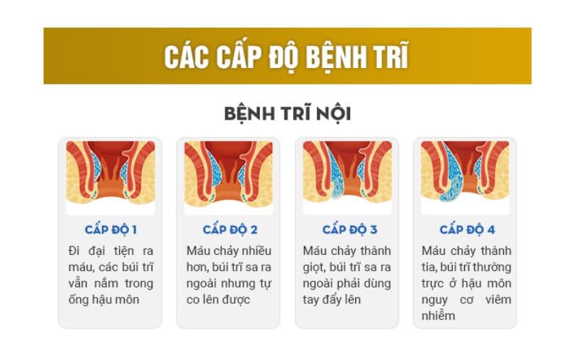 4 cấp độ của trĩ nội