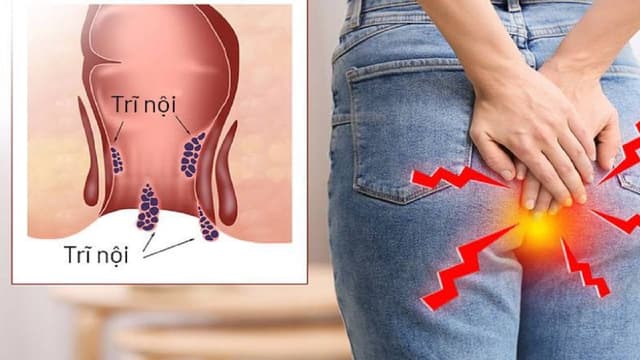 Trĩ nội biểu hiện thế nào – Nhận biết và điều trị hiệu quả