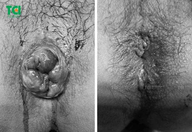 Hình ảnh hậu môn sau điều trị bằng Laser Diode