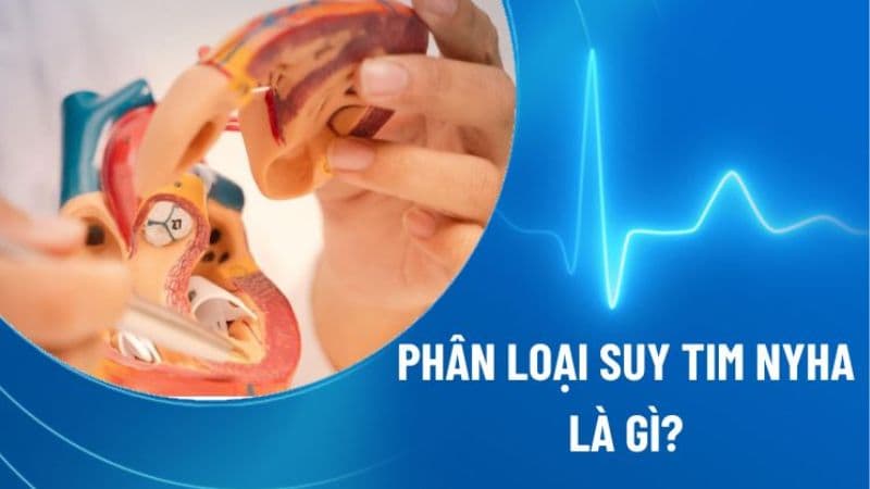 Phân loại suy tim theo phân độ NYHA và những triệu chứng tương ứng