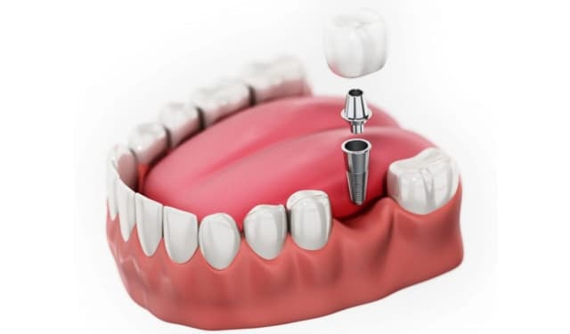 Lợi ích của việc trồng răng hàm và những ưu điểm nổi bật