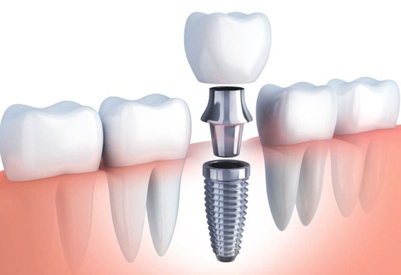 Trồng răng thật là phương pháp phục hình răng hiện đại, được nhiều người tin tưởng và lựa chọn hiện nay.