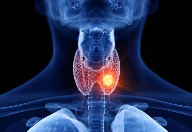 U giáp lành tính là gì?