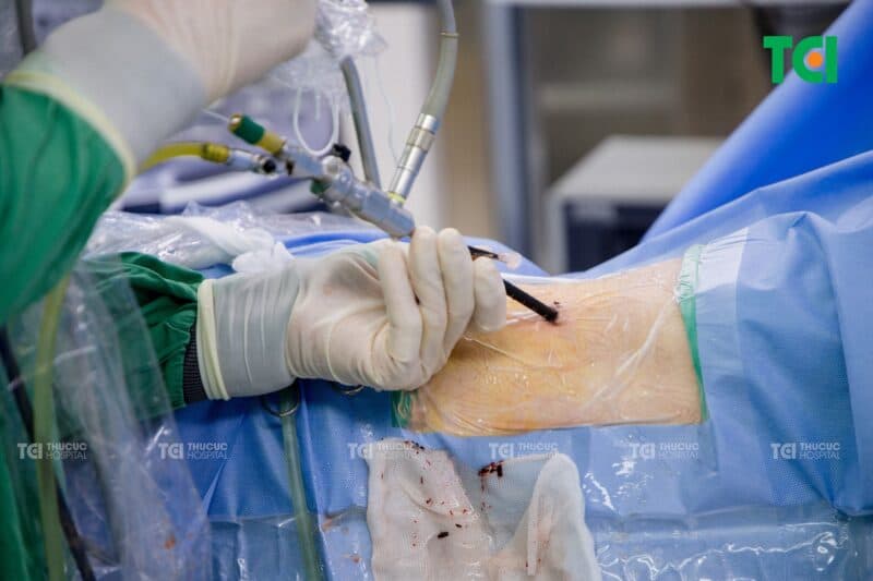 Ưu điểm nổi bật của tán sỏi thận qua da so với phương pháp truyền thống