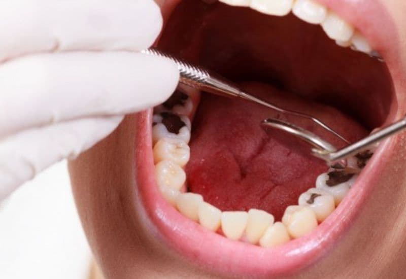 Vệ sinh răng sâu là yếu tố then chốt giúp chăm sóc và nâng cao sức khỏe răng miệng một cách toàn diện.