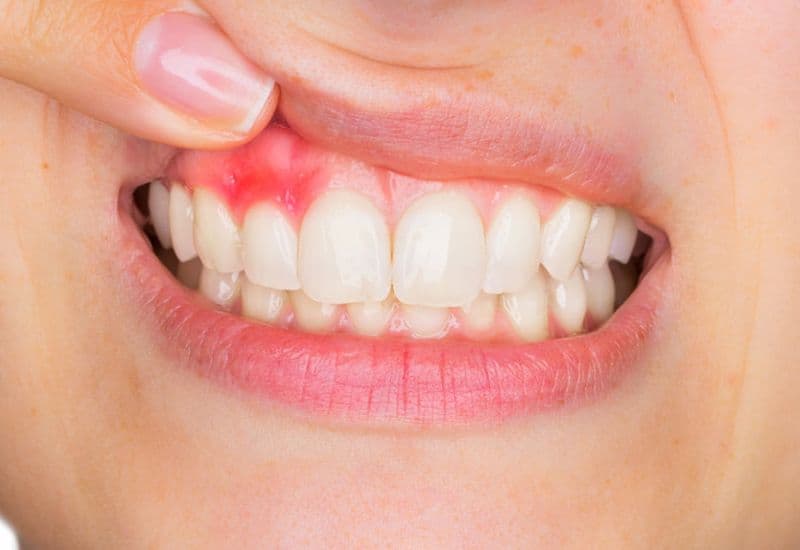 Viêm lợi chân răng nếu không điều trị sớm có thể gây hại nghiêm trọng cho sức khỏe răng miệng.