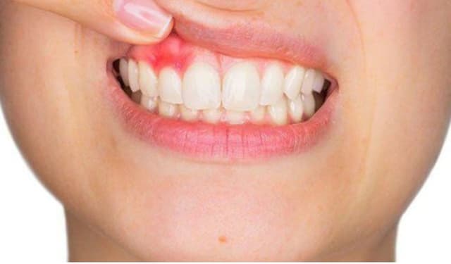 Nguy cơ tiềm ẩn từ viêm lợi trên và cách phòng ngừa hiệu quả