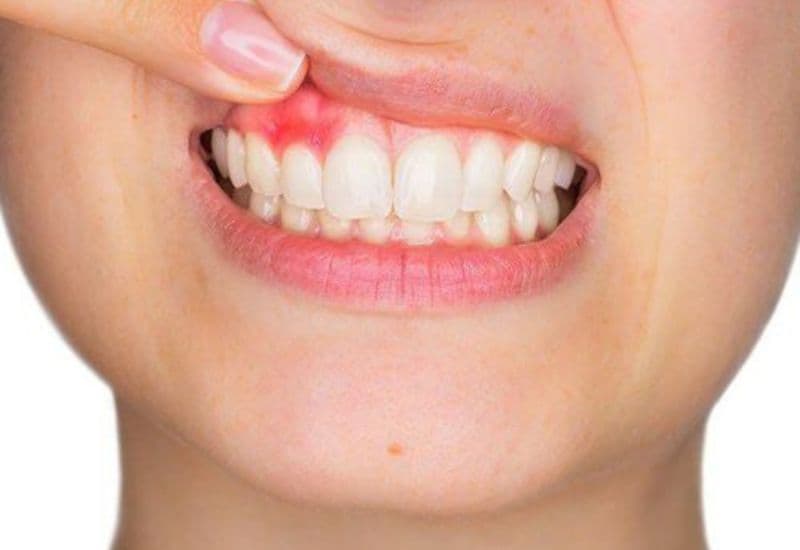 Viêm lợi trên xảy ra khi nướu quanh răng hàm trên bị viêm nhiễm