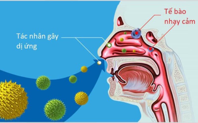 Viêm mũi xoang dị ứng nguy hiểm không