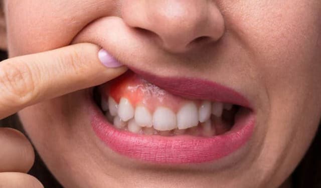 Tác hại lâu dài của viêm sưng lợi nếu không điều trị kịp thời