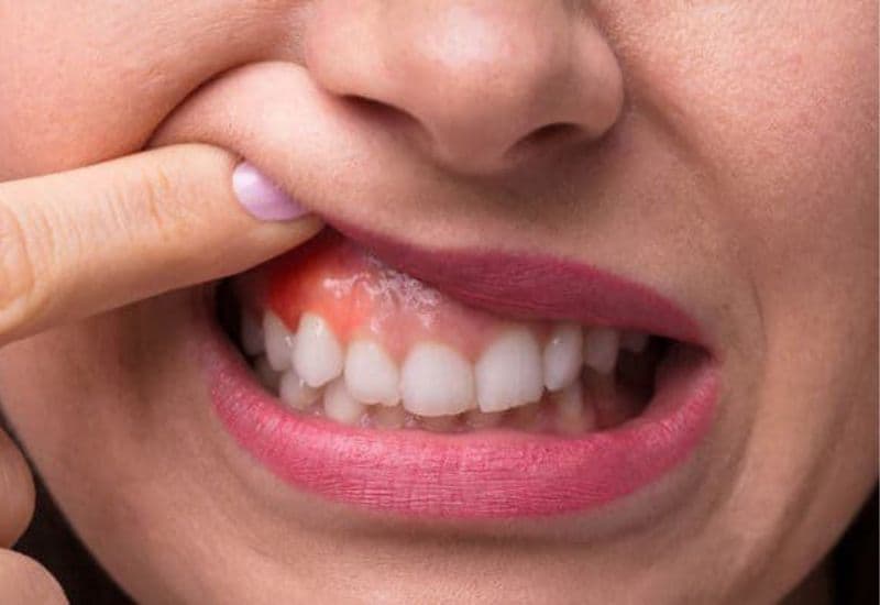 Viêm sưng lợi mang đến không ít phiền toái, ảnh hưởng đến chất lượng sống của người bệnh.