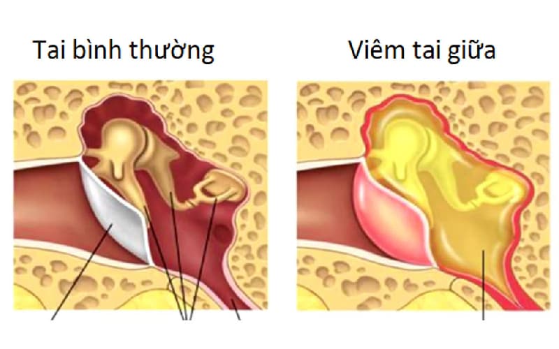 Viêm tai giữa trẻ em là gì