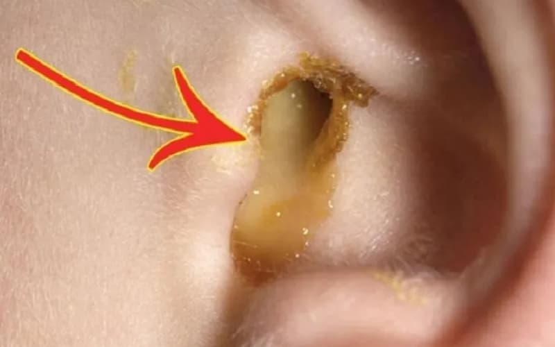 Viêm tai giữa trẻ em phổ biến không